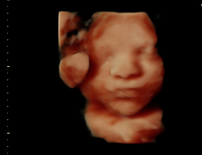 3D ultrasound image at 31 weeks